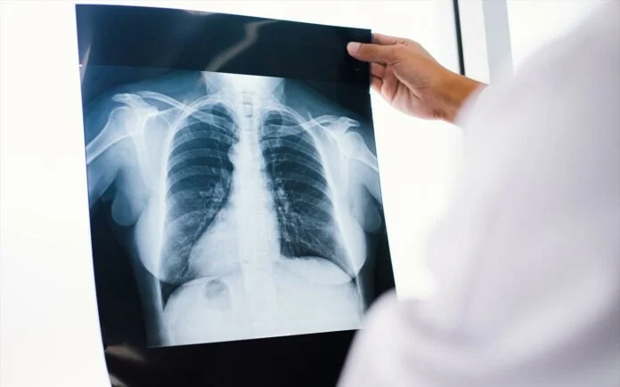 Καρκίνος Πνεύμονα: Ελληνική καινοτομία στην ανοσοθεραπεία