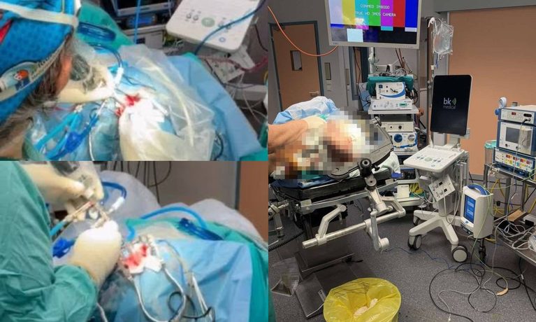 Αλεξανδρούπολη: Ενδοσκοπική εκκένωση εγκεφαλικής αιμορραγίας από την Πανεπιστημιακή Νευροχειρουργική